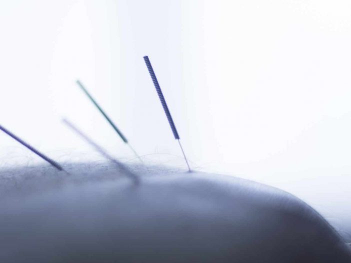 Everything you need to know about dry needling